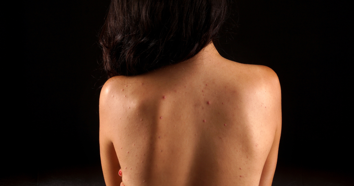 12 acne body wash formulations for clear skin