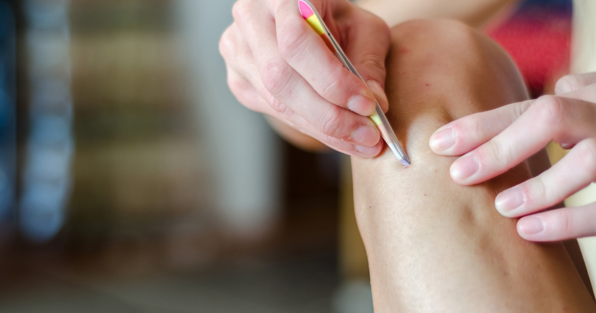 do ingrown hairs go away without treatment?